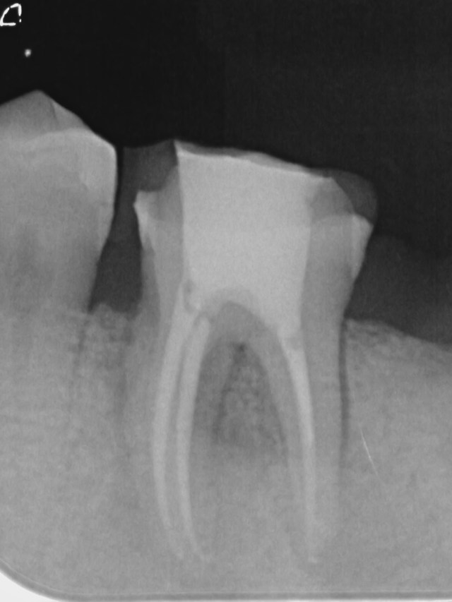 drg-m-furqan-crack-tooth-x-ray-004