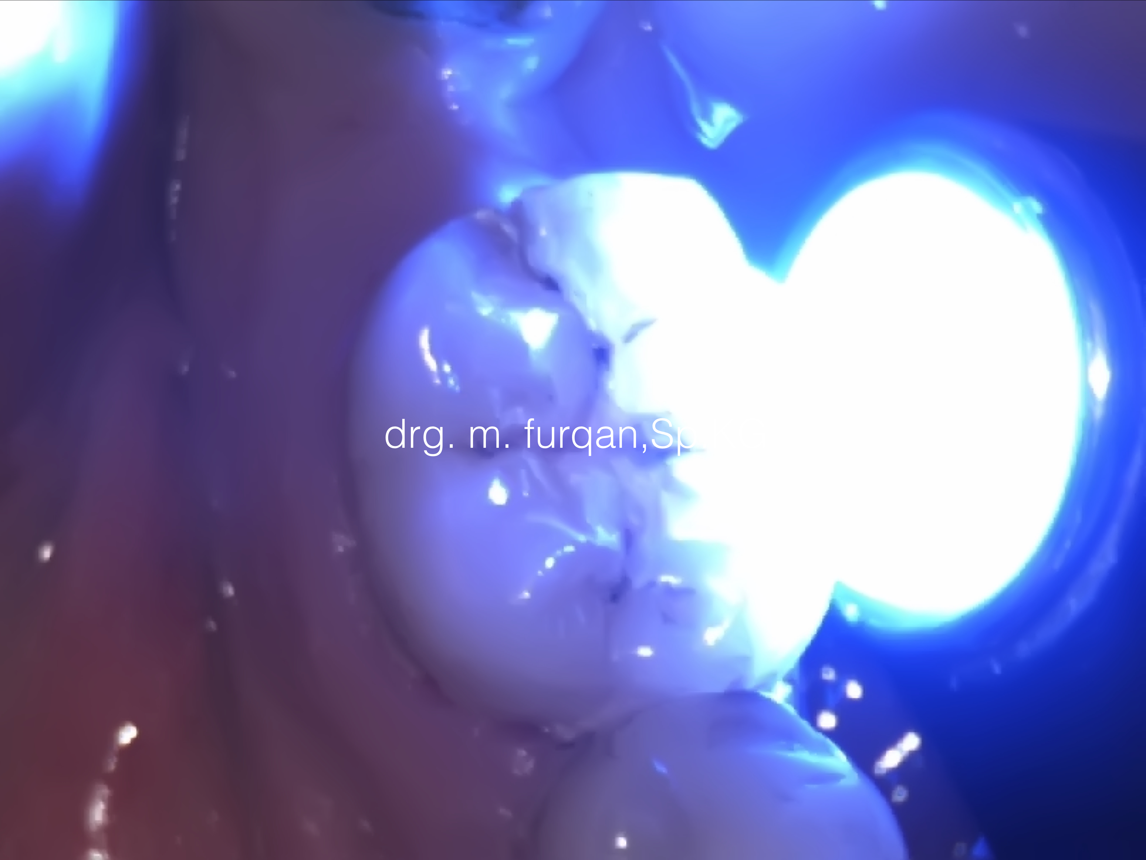 drg-m-furqan-sp-kg-crack-tooth-1-003