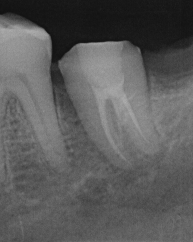drgmfurqanspkg-c-shape-crack-tooth15